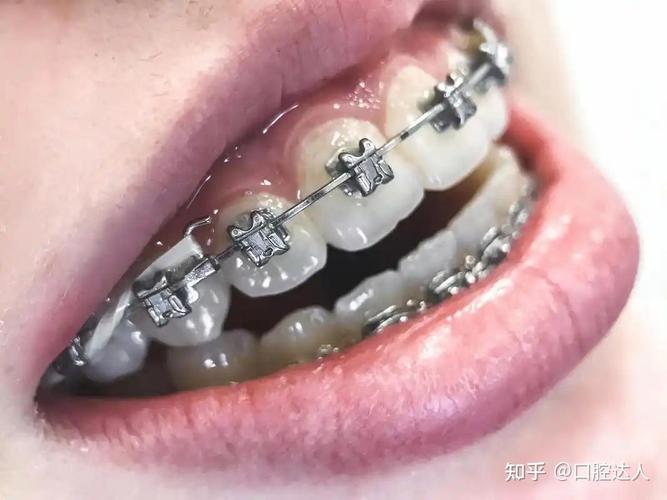 长沙19岁做牙齿矫正要花多少钱？一文说清费用明细