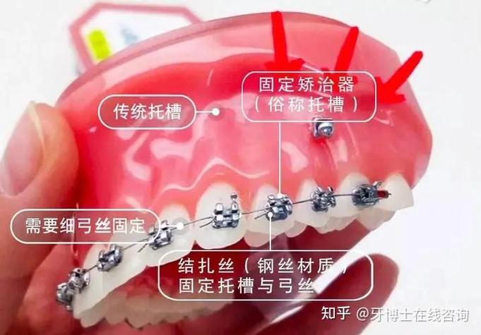 长沙深圳龙岗做隐适美矫正到底要花多少钱？