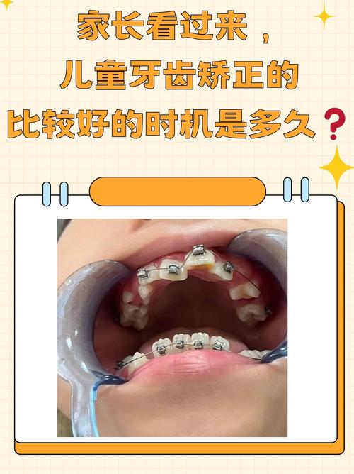 长沙8岁做牙齿矫正早不早？看情况，地包天要趁早