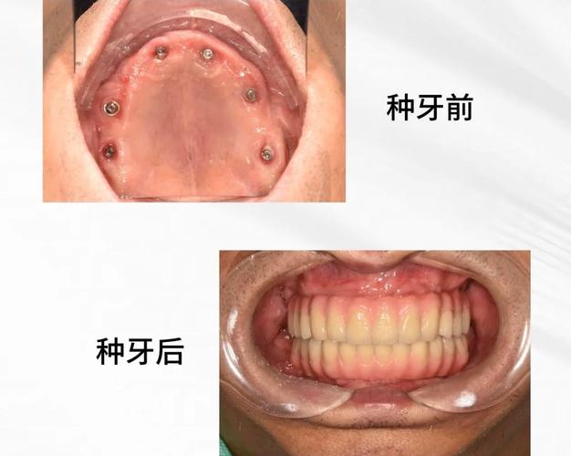 长沙全口种植牙手术到底怎么做