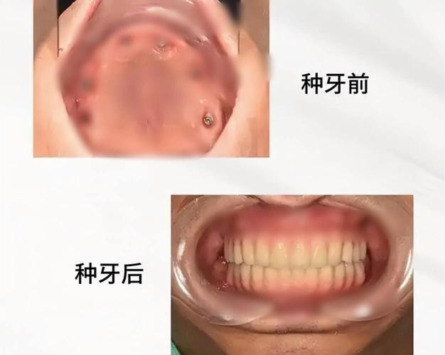 长沙70多岁还能种牙吗？种牙风险大不大？