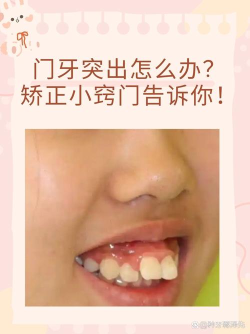 长沙10岁孩子门牙突出，医生揭秘：抓住黄金期，这个最快
