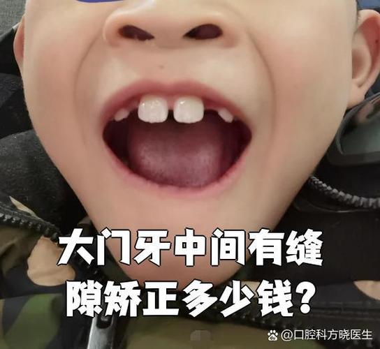 长沙12岁孩子矫正牙齿大概多少钱