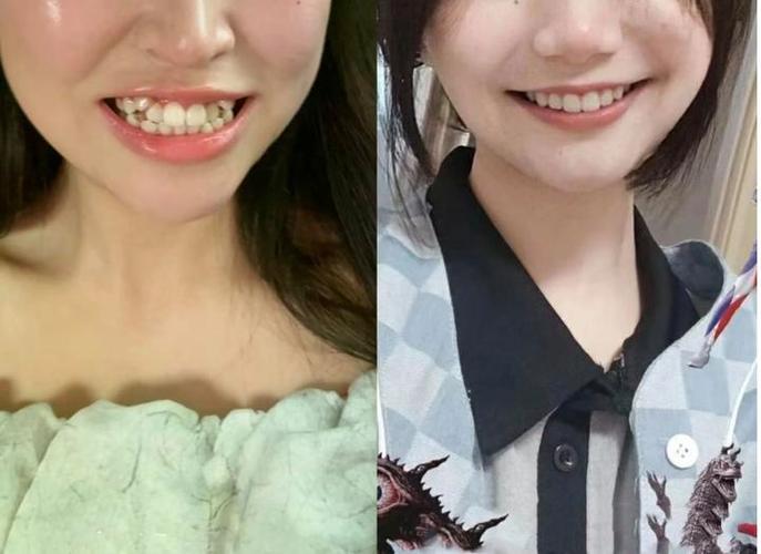 长沙36岁还能矫正牙齿吗 成人正畸的真相与风险