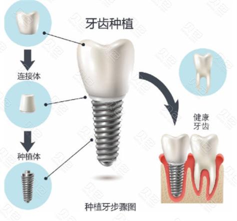 长沙九江威高种植牙多少钱一颗2026最新价格