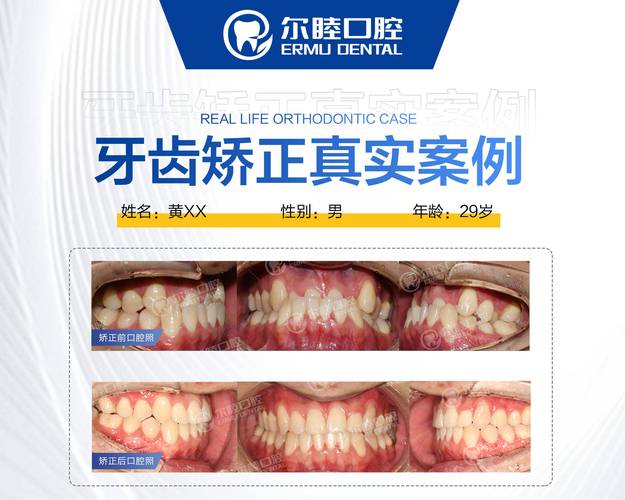长沙深圳南山做MRC矫正哪家医院靠谱？