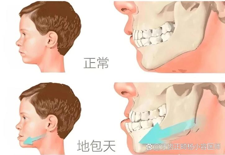 长沙12岁小孩能做牙齿矫正吗？别等换完牙才后悔