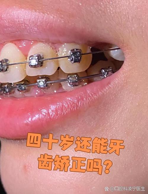 牙齿矫正可以改变脸型吗_牙齿矫正可以只做上排牙吗_40了可以矫正牙齿吗