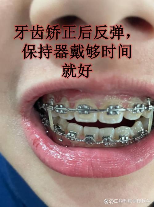 长沙6d牙齿矫正器有用吗？牙医揭秘：美容陷阱，小心伤牙