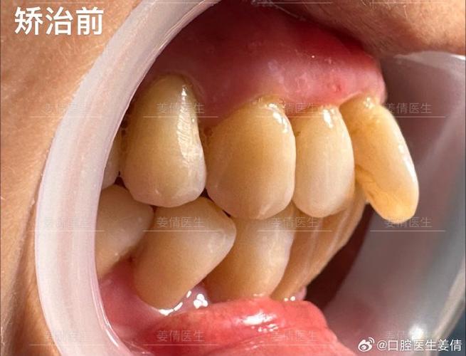 长沙60岁还能做牙齿矫正吗