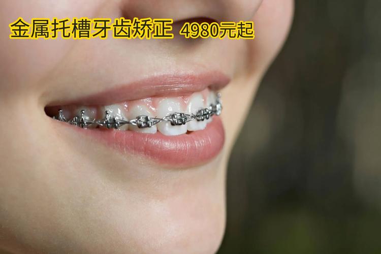 长沙珠海做牙齿矫正，不同牙套要花多少钱？