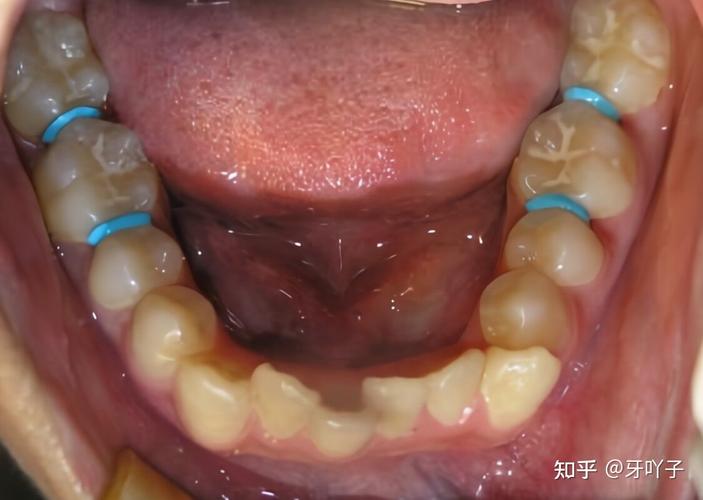 长沙玉林牙齿矫正效果怎么样？看完这篇就心里有数了