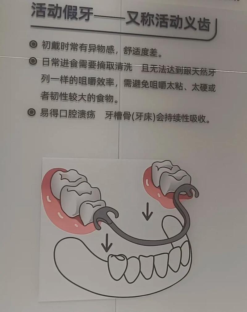 长沙活动假牙固定假牙种植牙哪个好 牙医一次说清别再被忽悠