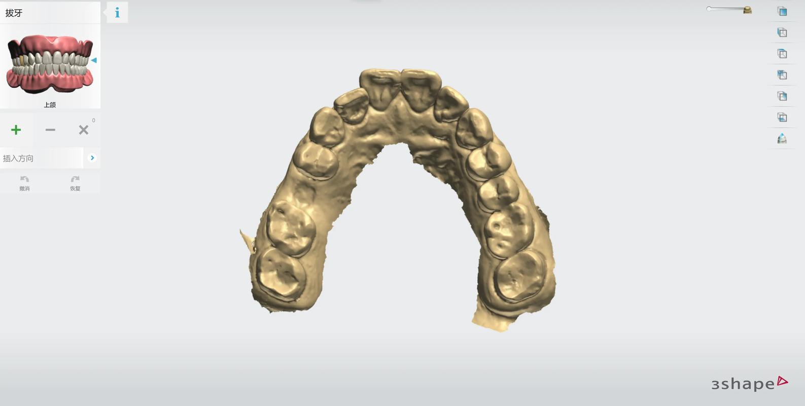 长沙3D导板数字化种植牙：告别传统盲种，种牙更精准更安心