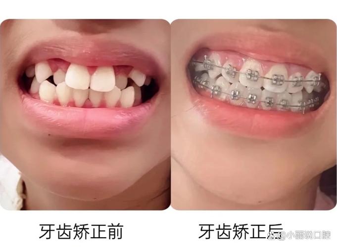 整齐牙齿_15岁牙齿不齐如何纠正_矫正整齐的牙齿
