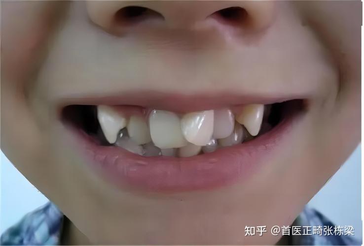长沙深圳儿童地包天最佳矫正年龄是多少？别等换牙误了大事