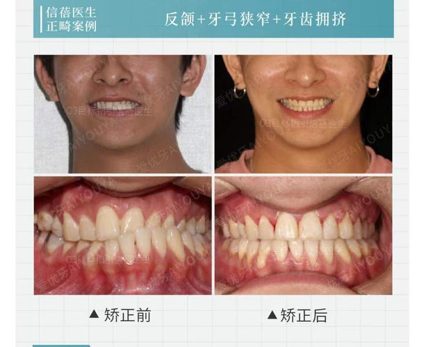 长沙深圳中学生牙齿矫正优惠活动真的靠谱吗？