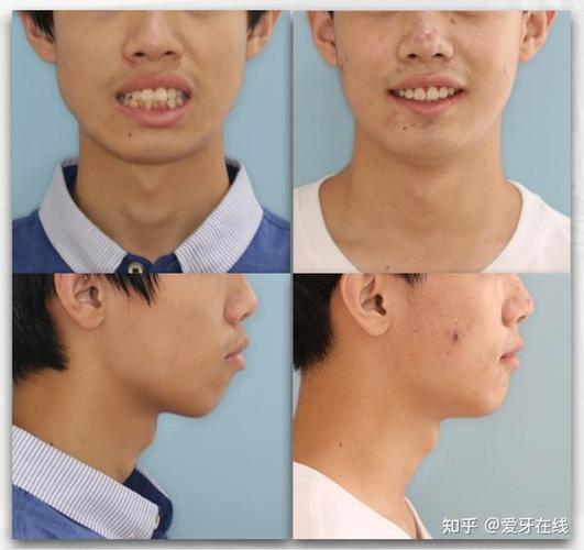 长沙呼和浩特牙齿矫正靠不靠谱？效果真实揭秘