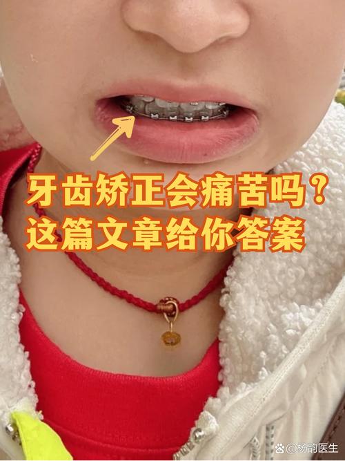 长沙19岁做牙齿矫正晚不晚 过来人告诉你真实经历