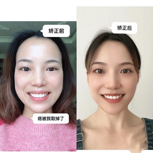 长沙成年人牙齿矫正还来得及吗