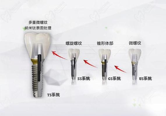 长沙唐山韩系奥齿泰种植牙2026最新费用一览