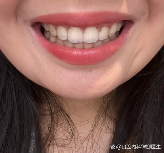 长沙23岁牙不齐还能整吗？正畸黄金期过了没