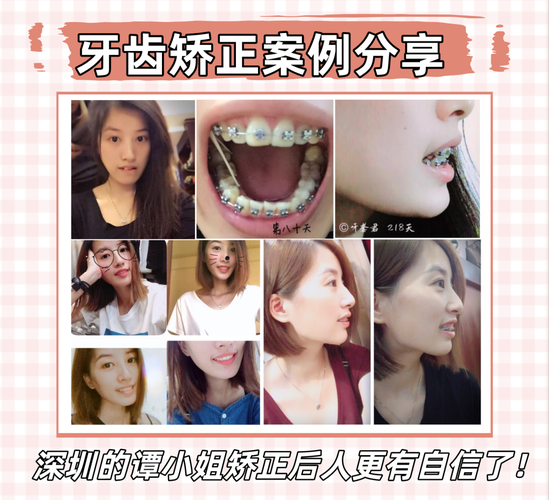 长沙深圳骨性龅牙正畸哪家医院靠谱？这3家别踩坑！