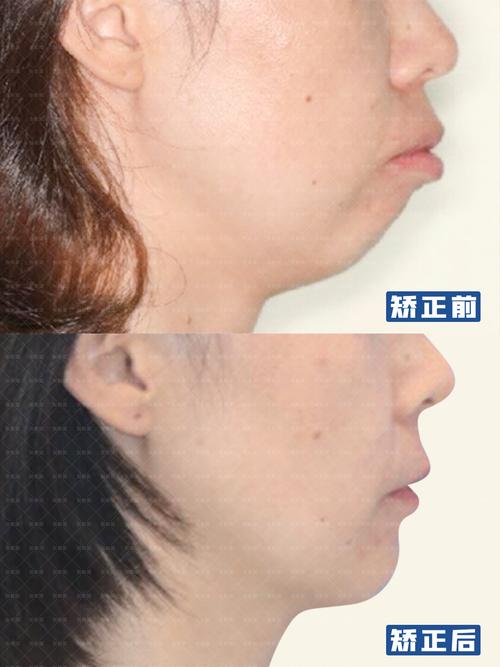 长沙矫正牙齿能改善下巴后缩吗？3个关键问题正畸医生一次说清