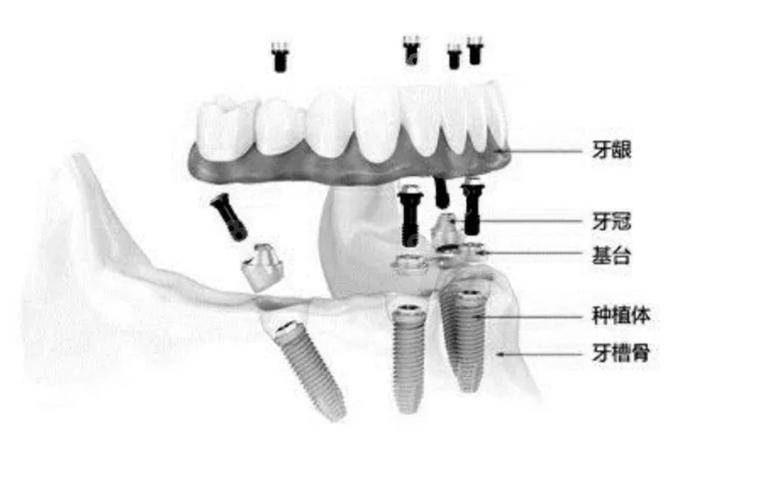 长沙半口种牙费用不固定 一颗大概多少钱