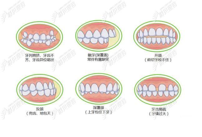 长沙南阳牙齿矫正多少钱？2026最新价格大公开
