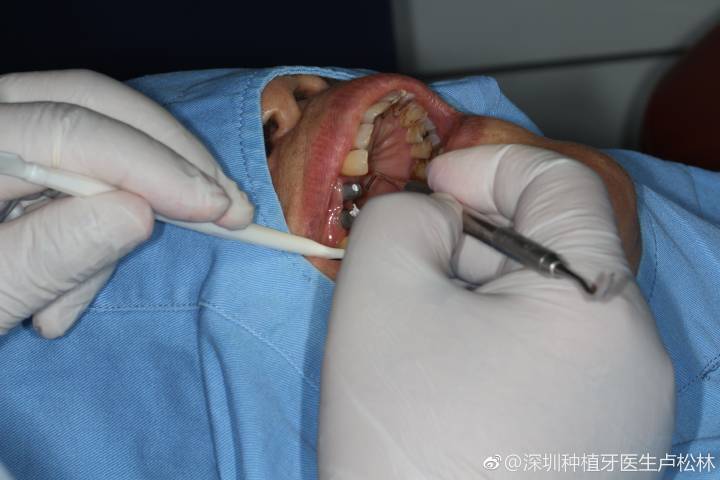 长沙80岁还能种牙吗？医生说只要满足这个条件就能做