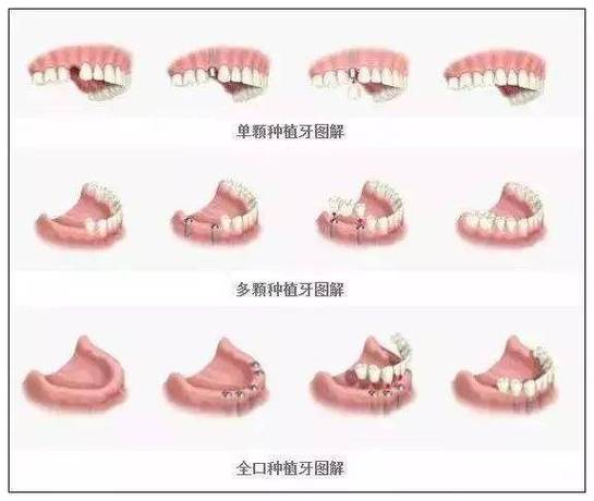 长沙半口种植牙全过程要多久？疼不疼？一步步讲清楚