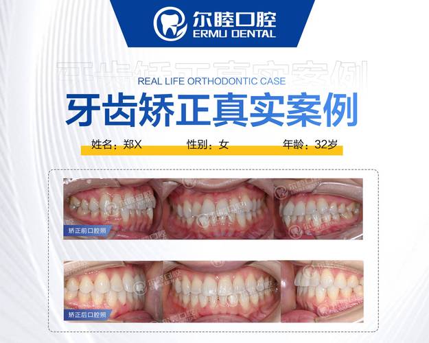 长沙成人矫正牙齿咬合疼不疼？效果和费用全解析