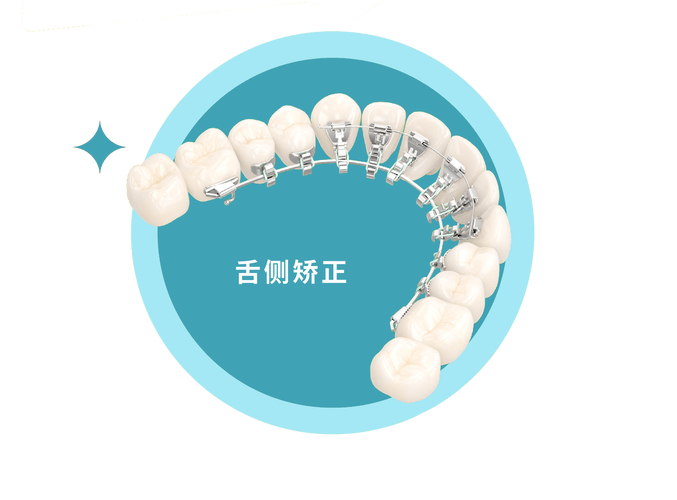 长沙成年人牙齿舌侧正畸到底值不值？看完这几点就懂了