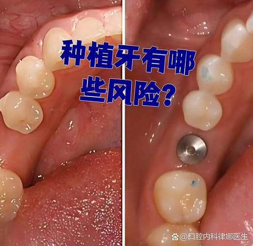 长沙全口种植牙的风险和后遗症有哪些