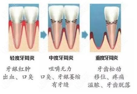 长沙深圳牙周炎治疗到底要花多少钱？2026最新费用解析