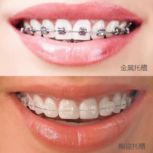 长沙深圳深覆合矫正费用大揭秘：到底多少钱才靠谱？