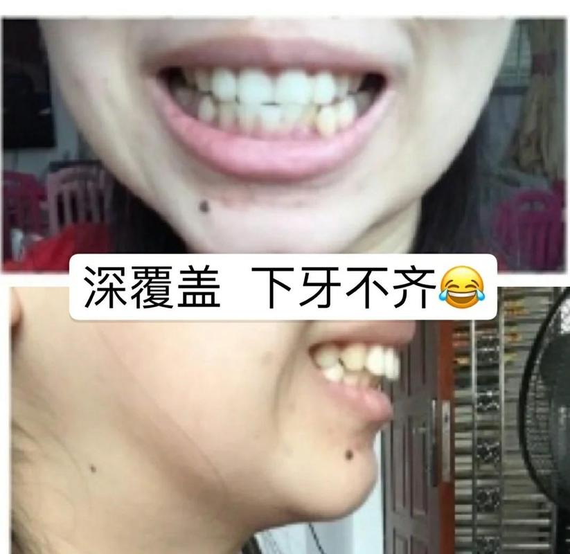 长沙39岁牙齿矫正还有用吗 真实效果看这里