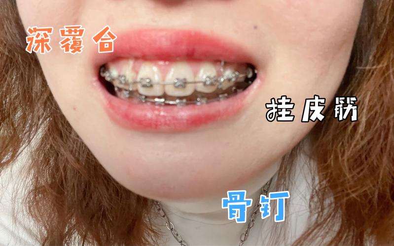 长沙深圳深覆合正畸去哪家好？牙科推荐避坑指南